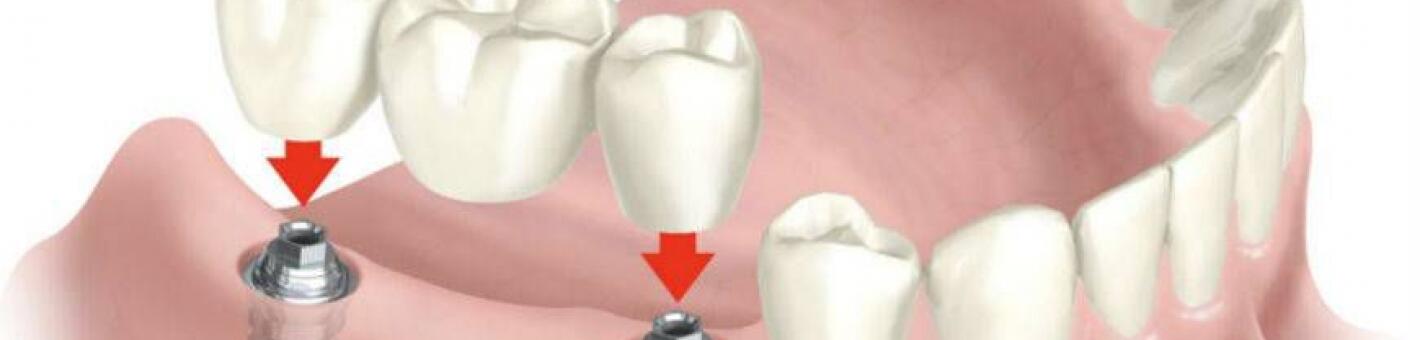 Восстановление дефекта зубного ряда металлокерамической коронкой на имплантате