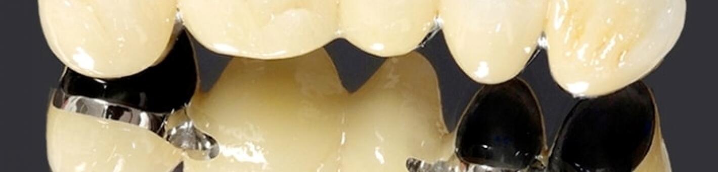  Восстановление дефекта зубного ряда металлокерамическим мостовидным протезом