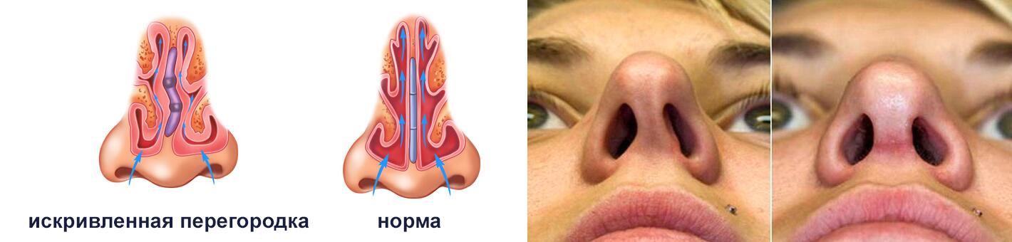 Эндоскопическая подслизистая резекция перегородки носа