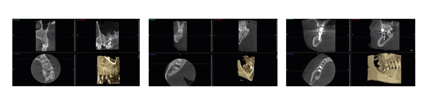 Конусно-лучевая компьютерная томография («3Д-томография, дентальная объемная томография»)