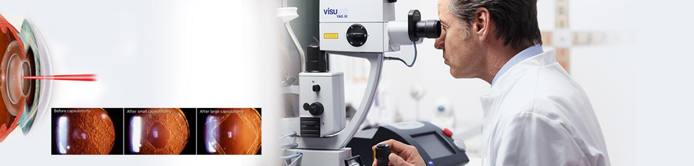 YAG-лазерная дисцизия вторичной катаракты (капсулотомия)